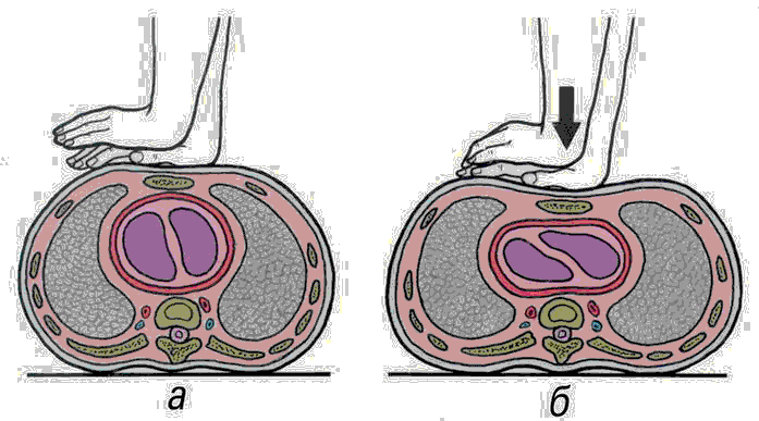 Положение рук при непрямом массаже сердца фото